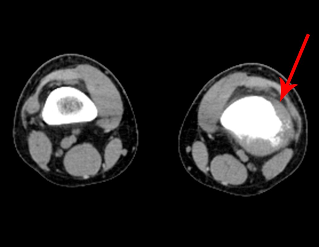 Figura 10: Tomografia de 18/09/2015. Aseta vermelha aponta a densidade aumentada no canal medular e o tumor extracortical.