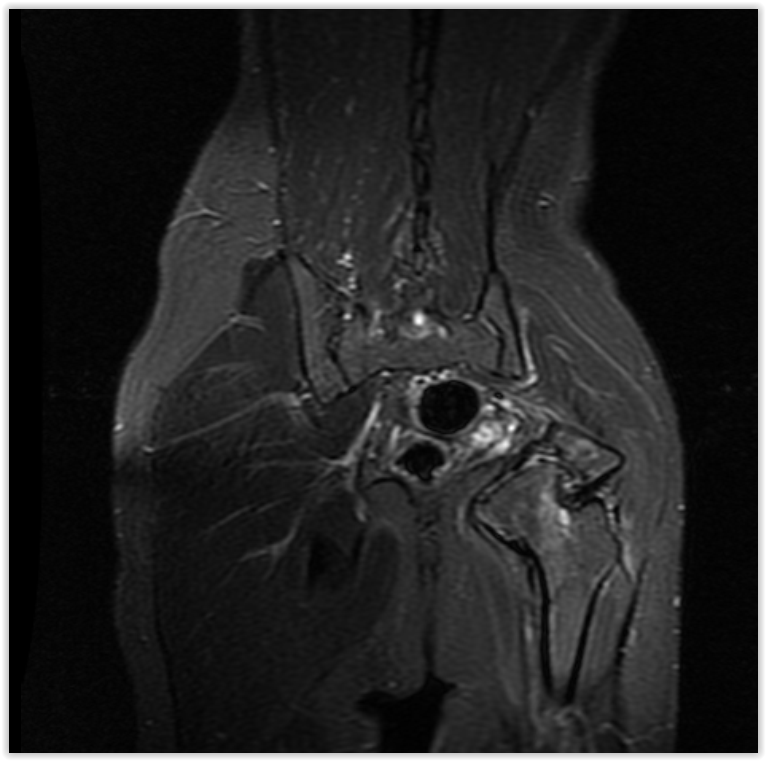 Figura 94: Rm cor T1, com saturação de gordura, mostrando o pequeno apoio da cabeça femoral no teto acetabular remanescente, porém indolor e com boa função.