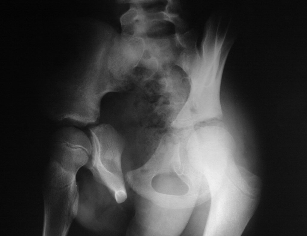 Figura 16: Radiografia de bacia em obturatriz, pós quimioterapia pré-operatória.