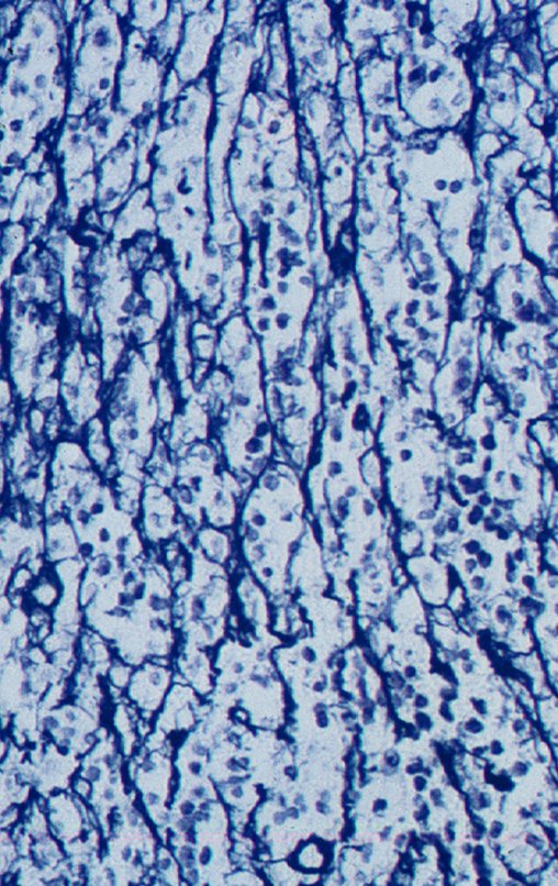 Figura 10: Exemplo de caso de Linfoma, que faz diagnóstico diferencial com sarcoma de Ewing, que tem reticulina positivo, simulando uma "tela de galinheiro", envolvendo as pequenas células do linfoma.