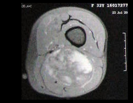 Figura 12: Rm ax T1 com saturação de gordura, lesão de tecidos moles posterior da coxa esquerda.