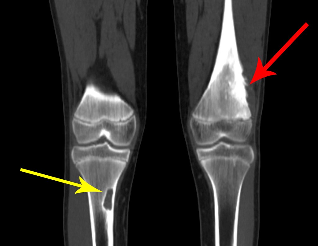 Figura 11: Tomografia em corte coronal, Seta vermelha assinalando a lesão na metáfise distal do fêmur. Seta amarela assinala a lesão pseudo neoplásica na cortical medial da tíbia direita.