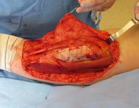 Figura 37: Prossegue-se dissecando todo o subcutâneo da incisão cirúrgica e cauterizando os vasos sangrantes, para uma cirurgia segura.