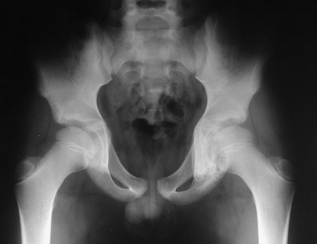 Figura 14: Radiografia de bacia, após quimioterapia pré-operatória, com melhora radiográfica do ísquio, denotando boa resposta ao tratamento.