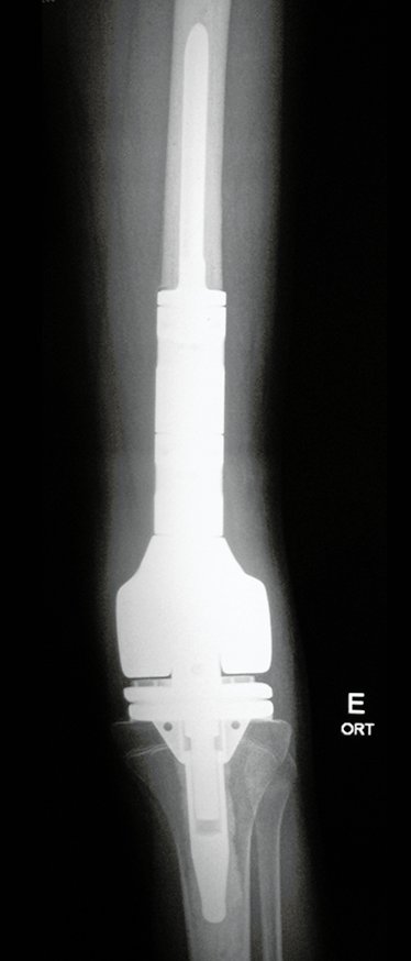 Figura 72: Radiografia de 30/03/2016, post op 3 meses, frente.