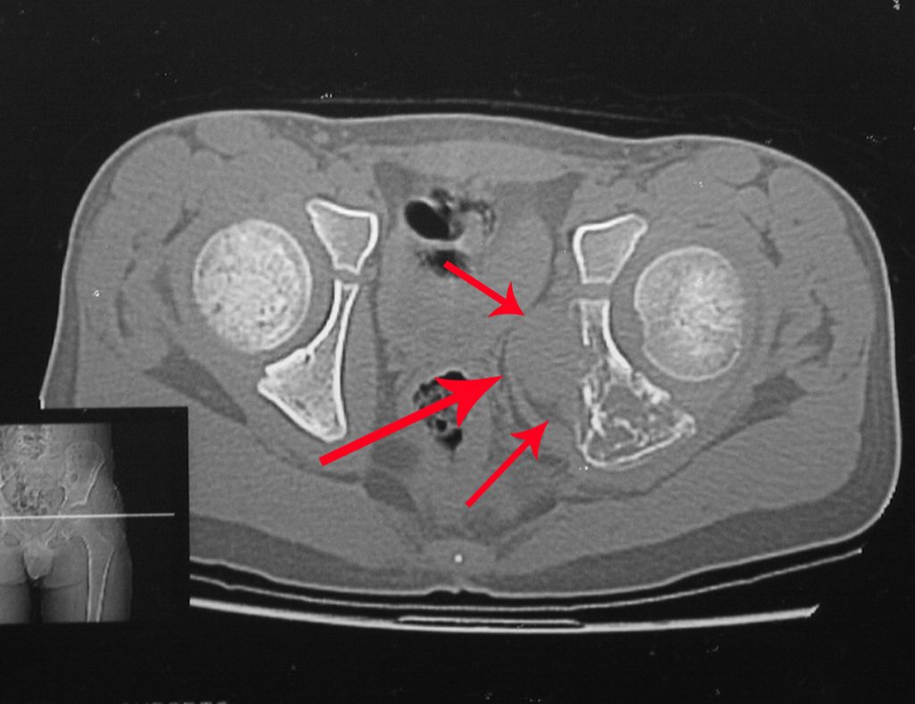 Figura 7: Tomografia computadorizada, com lesão de rarefação óssea no ísquio esquedro, com grande massa tumoral extra-cortical, característica do sarcoma de Ewing.