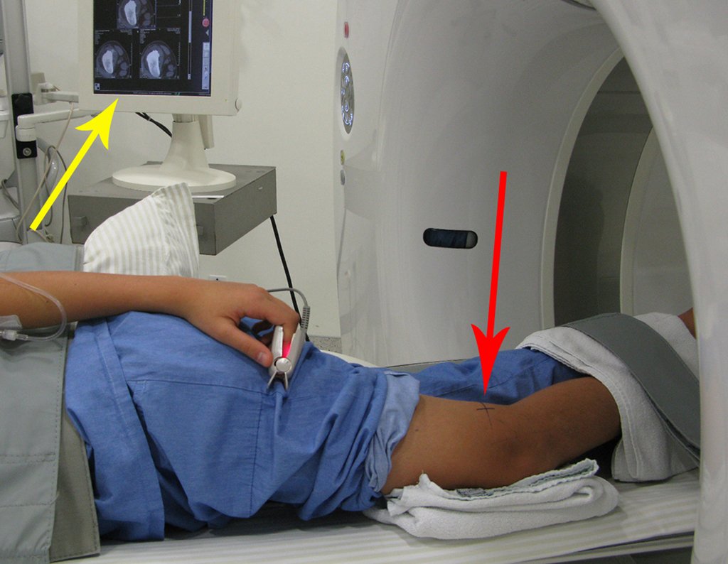 Figura 20: Posicionamento do paciente em decúbito prono, para fascilitar a acesso póstero lateral da biópsia, seta vermelho. A seta amarela assinala o controle tomográfico do ponto exato para a biópsia.