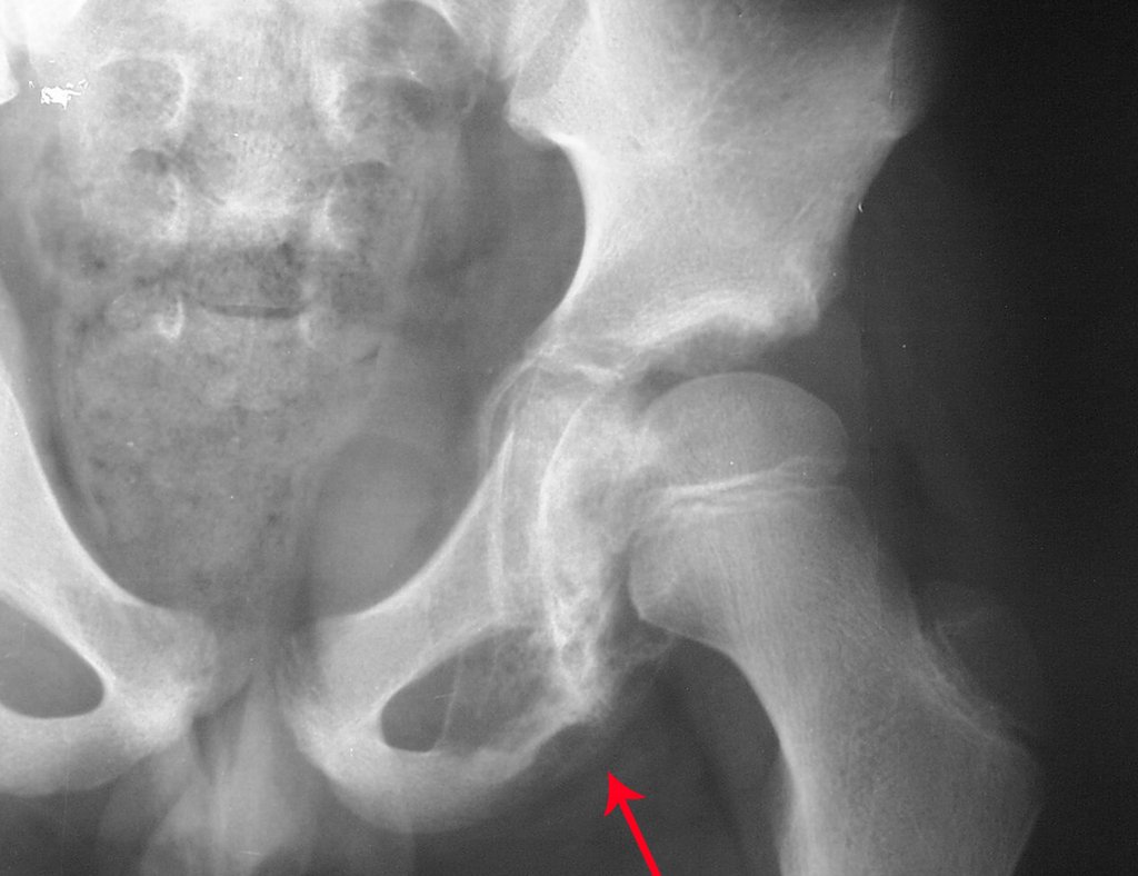 Figura 2: Radiografia de bacia frente, evidenciando o acometimento de parte do teto acetabular. Pré Qt.