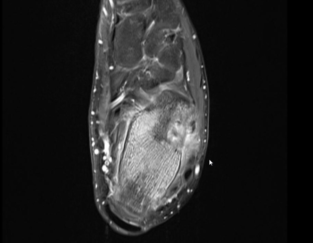 Figura 29: RM axial T1, fat sat, com lesão na porção lateral do calcâneo e edema extraósseo.