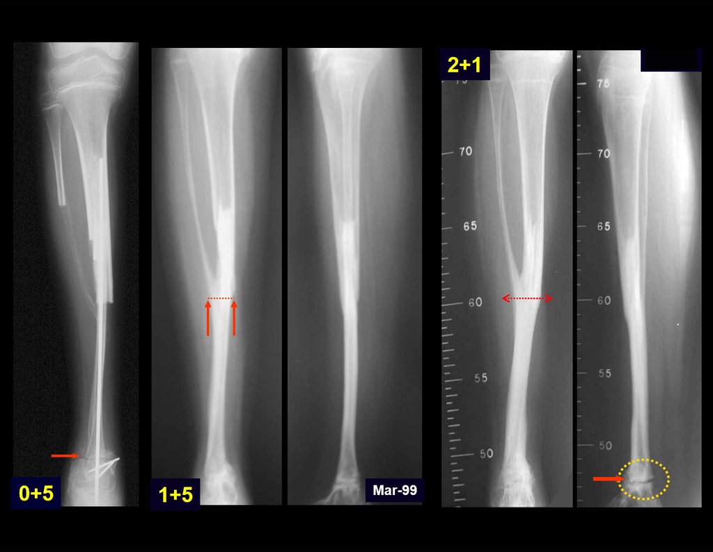 Figura 46: Radiografias ilustrando a evolução do autotransplante de cartilagem de crescimento, desde o pós-operatório precoce até após dois anos e um mês da reconstrução.