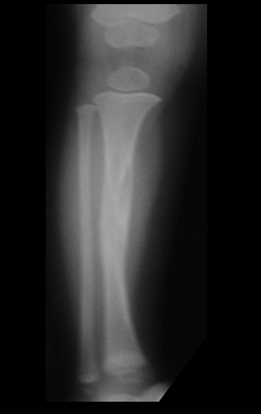 Figura 12: Radiografia de frente, realizada em 18/02/2008, com a evolução da lesão.