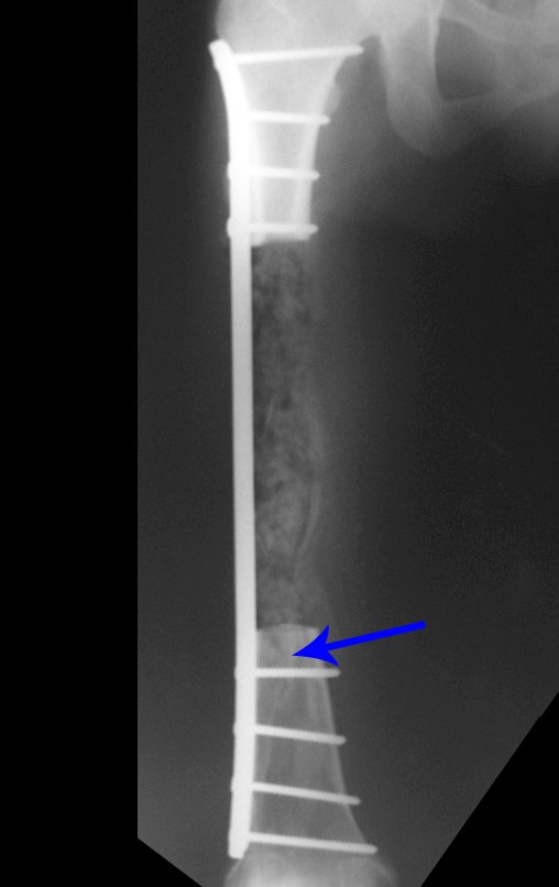 Figura 37: Radiografia, frente, reconstrução com enxerto ósseo autólogo e osteossíntese com placa especial.