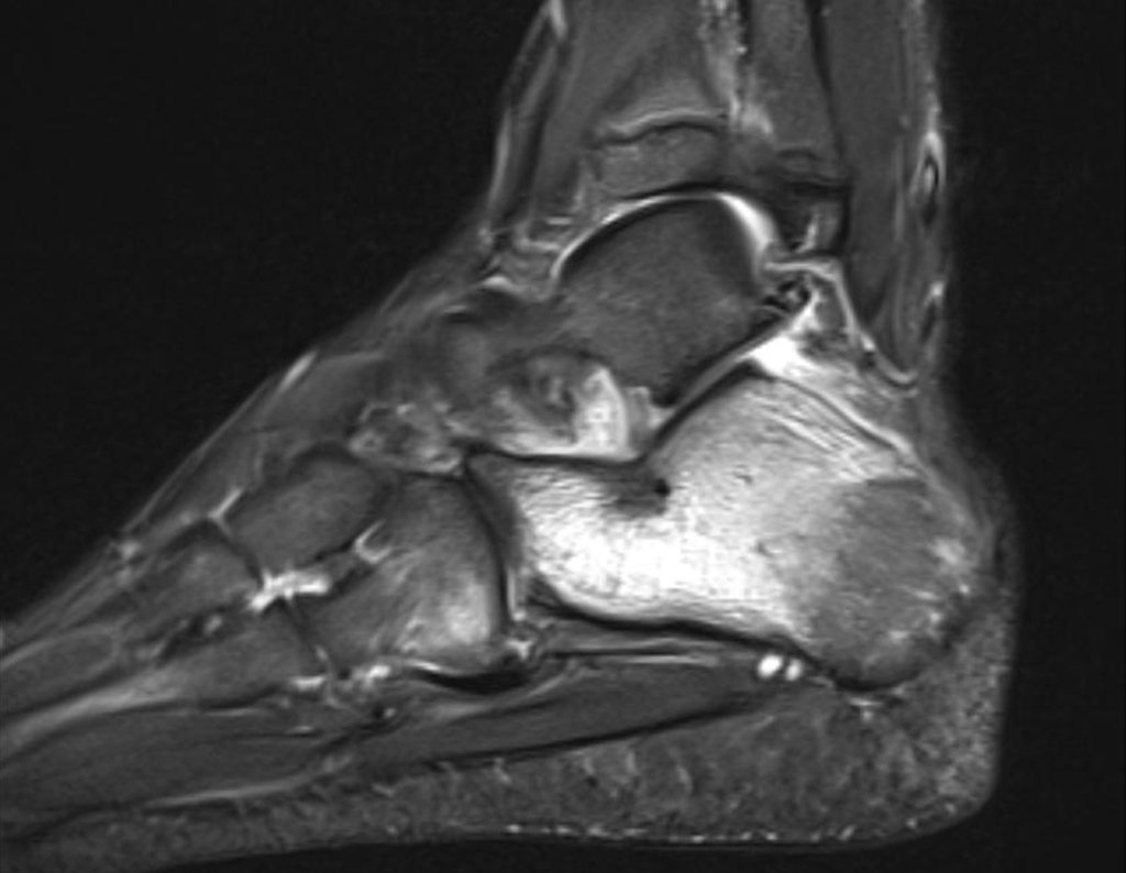 Figura 27: RM sag T2 stir, lesão e edema do calcâneo.