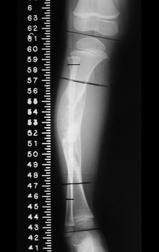 Figura 90: Planejamento pré-operatório, radiografia com régua, frente, com a marcação dos níveis das osteotomias.