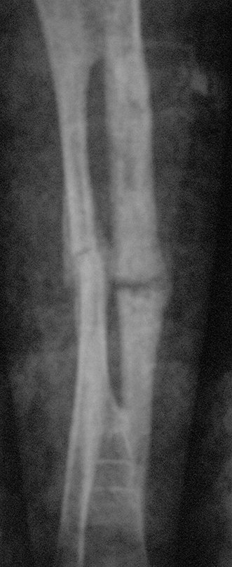 Figura 146: Fratura consolidada, radiografia de controle após dez semanas, frente, em 19/12/2013.