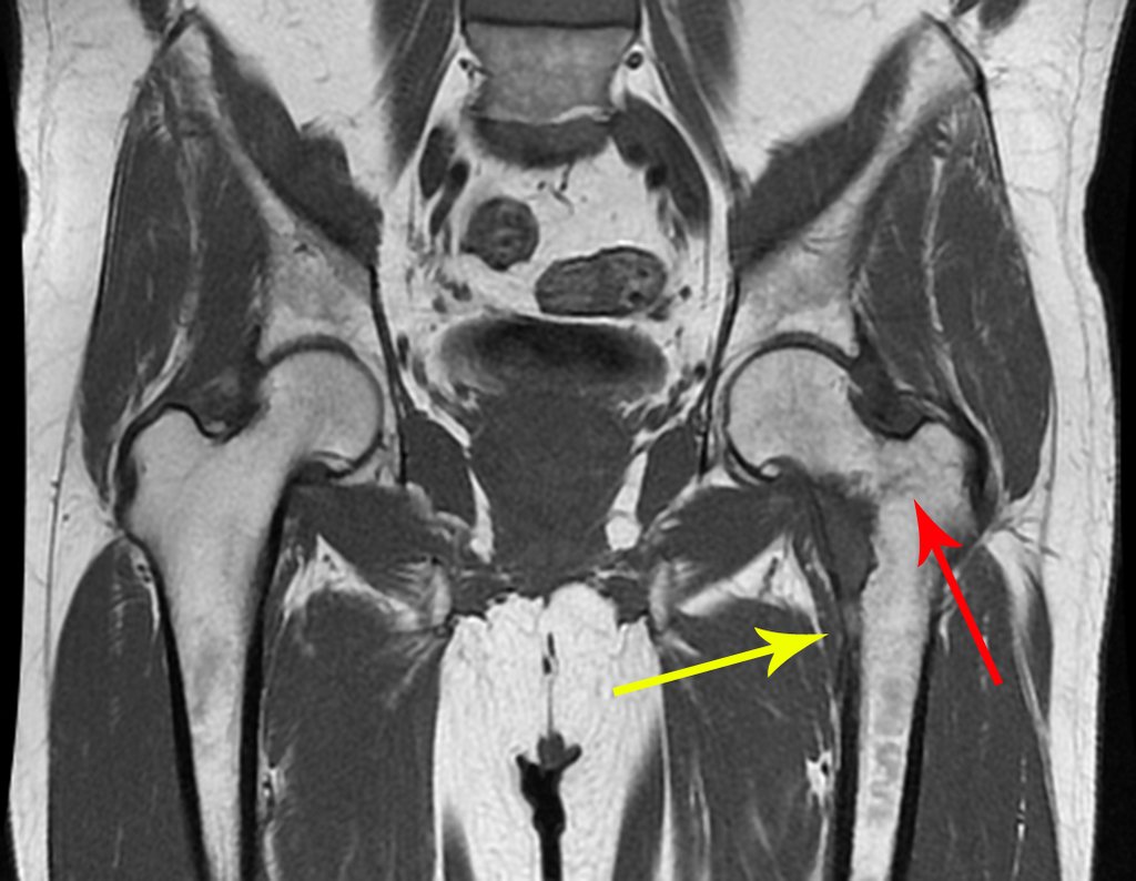 Figura 49: RM coronal T1 com falha na cortical medial, seta amarela e linhas de força do grande trocânter com traços de fragilidade, stress.