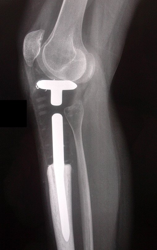 Figura 110: Radiografia em perfil, pós-operatório de dez meses.