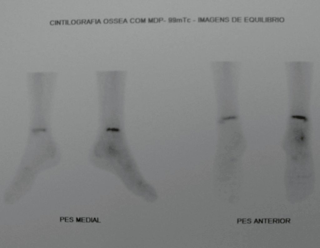 Figura 5: Cintilografia, na fase de equilíbrio, com evidente captação no calcâneo.