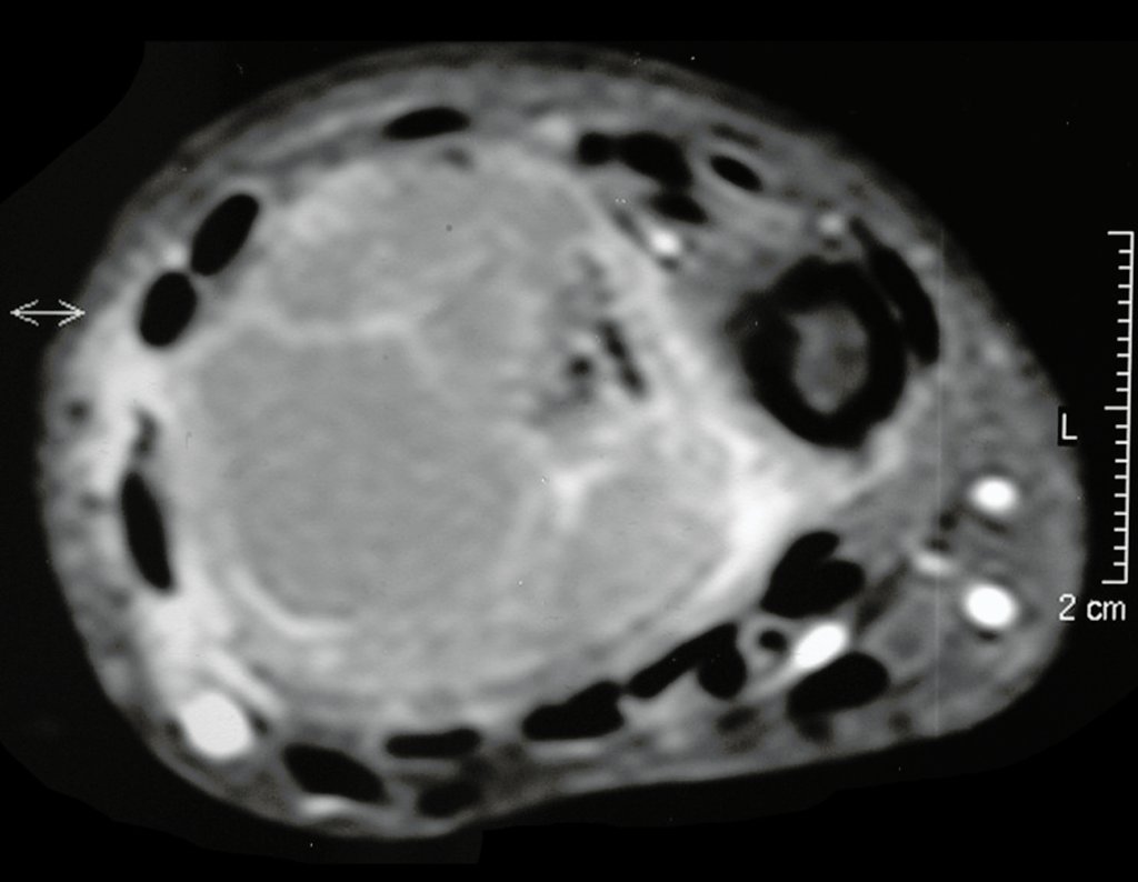 Figura 35: RM ax t1, lesão com captação de contraste na periferia e em septos do tumor.