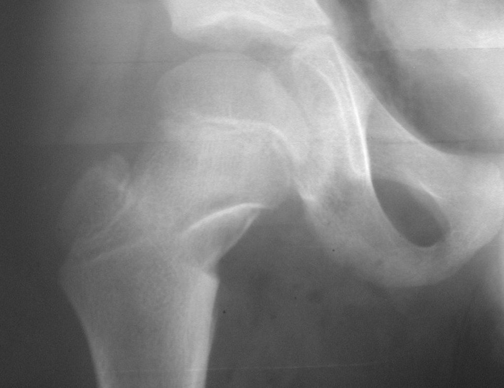 Figura 42: Radiografia de controle pós-operatório, após a ressecção da lesão e reconstrução com enxerto autólogo.