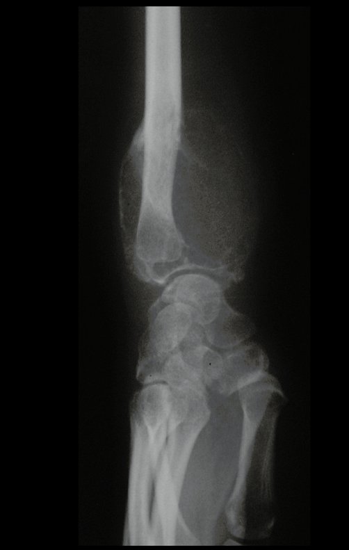 Figura 10: RX, após dez meses, progressão do tumor, com erosão circunferencial da cortical, deformando a articulação do punho.