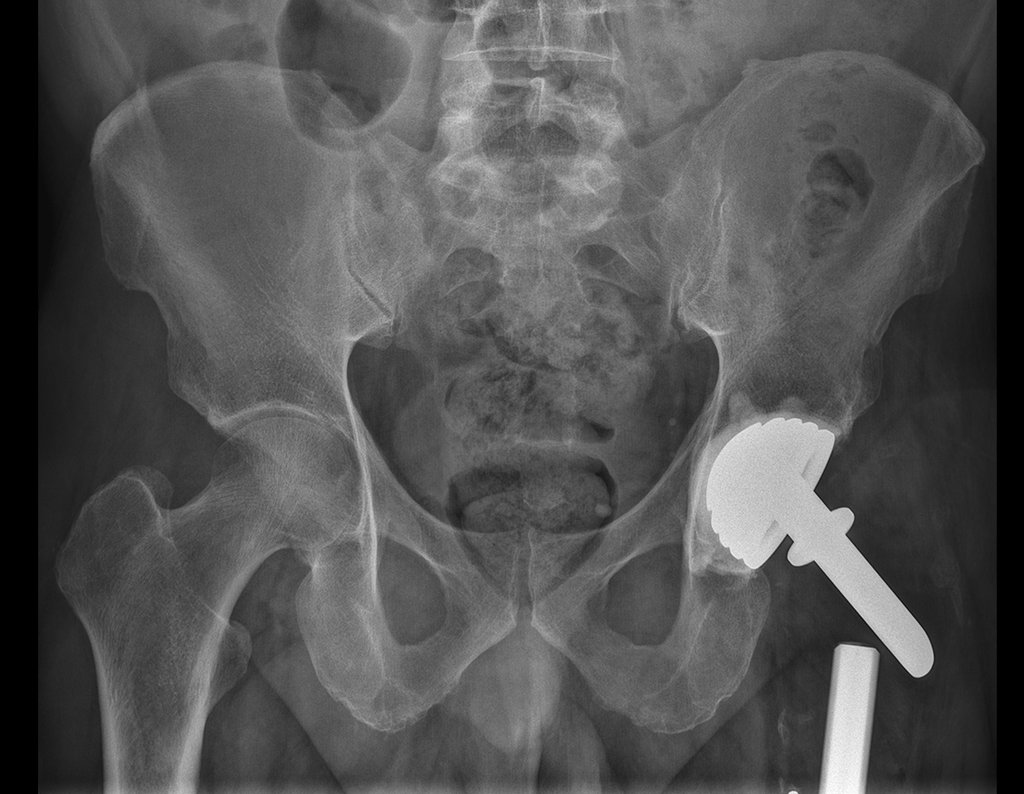 Figura 126: Radiografia de bacia, em 03/08/2017.