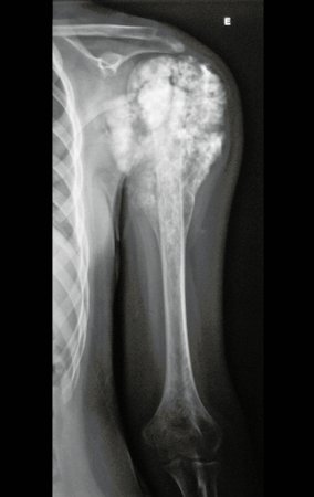 Figura 1: Radiografia do úmero esquerdo frente, evidenciando a lesão meta epifisária com grande componente extracortical. O tumor estende-se distalmente pela diáfise umeral.