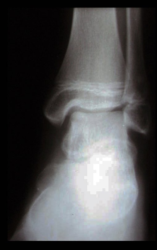 Figura 1: Radiografia do tornozelo frente.