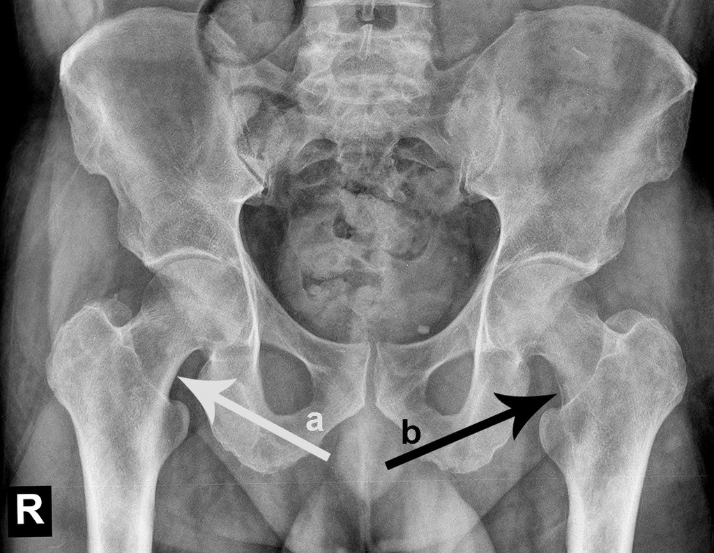 Figura 1: Radiografia da bacia evidenciando lesão de rarefação óssea no colo femoral esquerdo e região trocanteriana. A seta b, em negro, salienta a erosão da cortical medial.