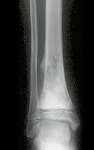 Figura1: Radiografia frente do tornozelo direito, com lesão meta-epifisaria da tíbia, com limites imprecisos e triângulo de Codmann.