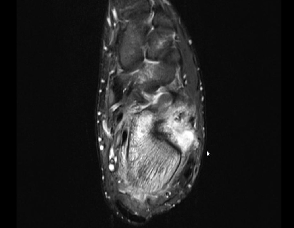 Figura 33: RM axial T2 stir, halo de esclerose, lesão e edema articular.