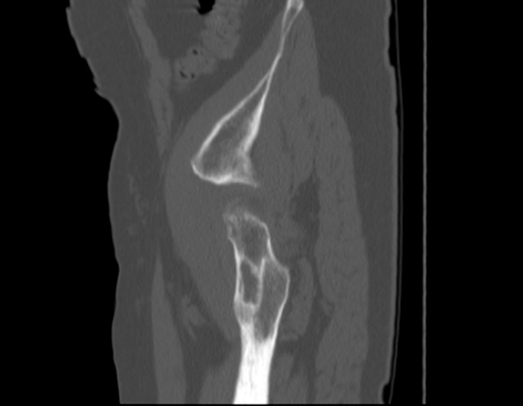 Figura 38: Tomografia sagital com lesão lítica maior do que um terço do diâmetro do osso.