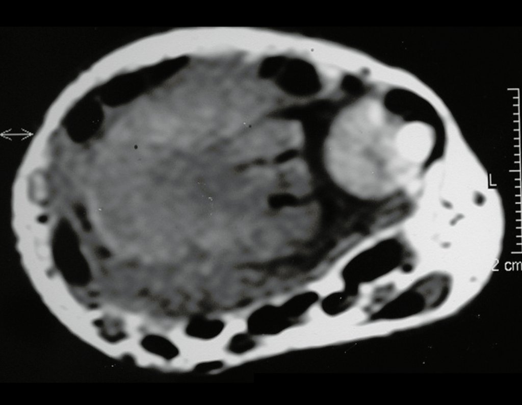 Figura 27: RM ax t1, lesão com sinal intermediário, empurrando ligamentos e tendões, que fazem impressão no tumor. Não há infiltração em tecidos moles. Este tumor geralmente empurra os tecidos moles, sem infiltrá-lo.