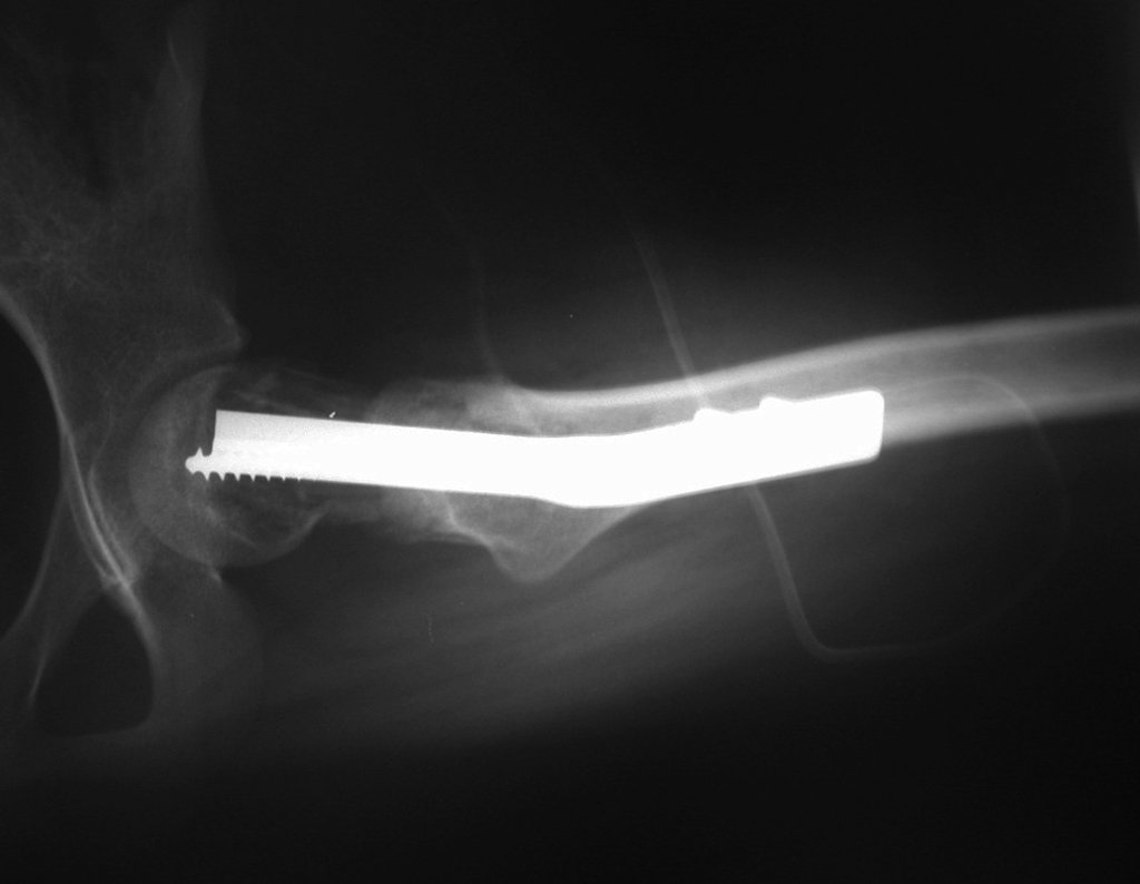 Figura 83: Radiografia do pós-operatório imediato, perfil.