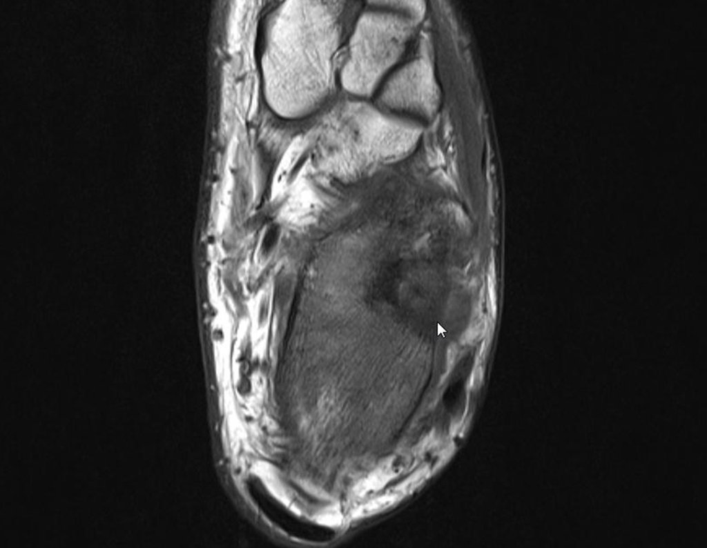 Figura 23: RM axial T1, lesão na região lateral do calcâneo.