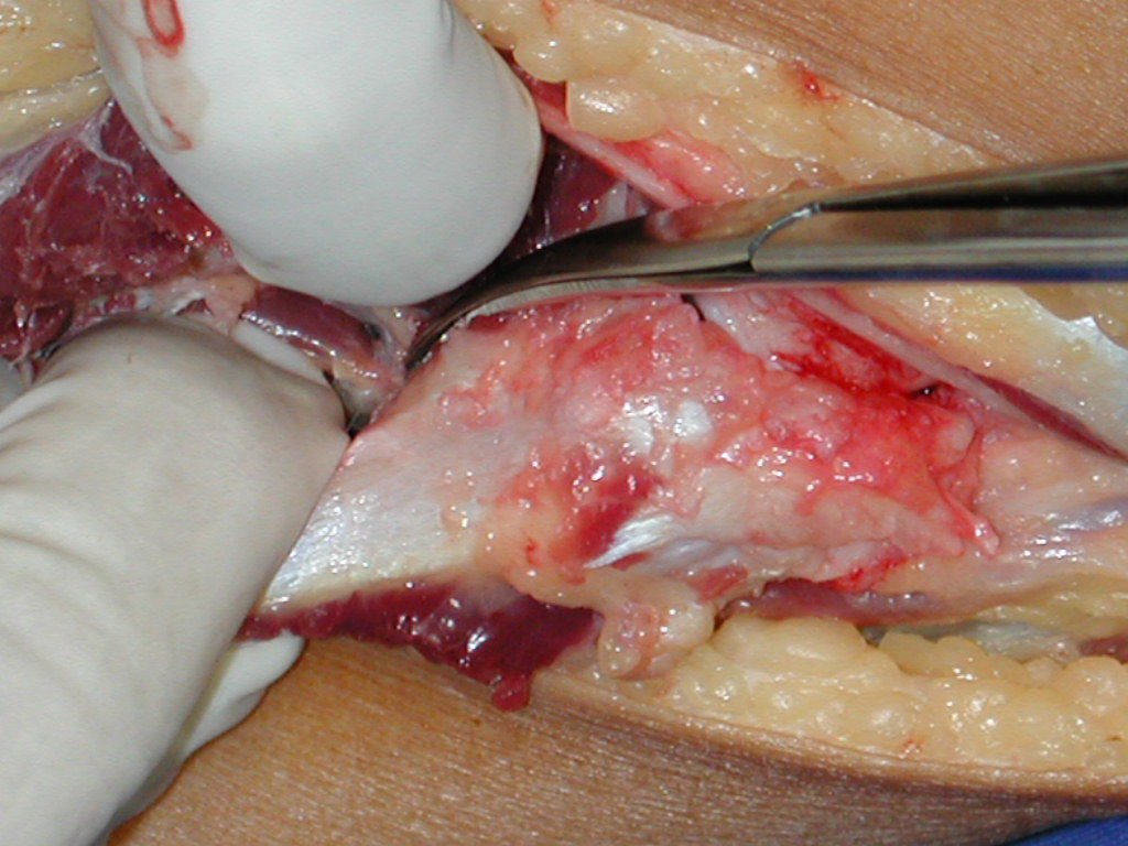 Figura 67: Liberação da articulação tibio-fibular proximal, seccionando-se os ligamentos anterior, posterior, e parte do ligamento arqueado, que servirão para ancoragem na reconstrução do punho.