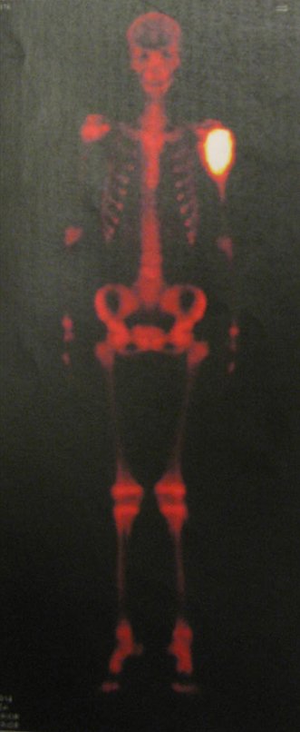 Figura 6: Cintilografia colorida destacando a intensa captação da lesão.