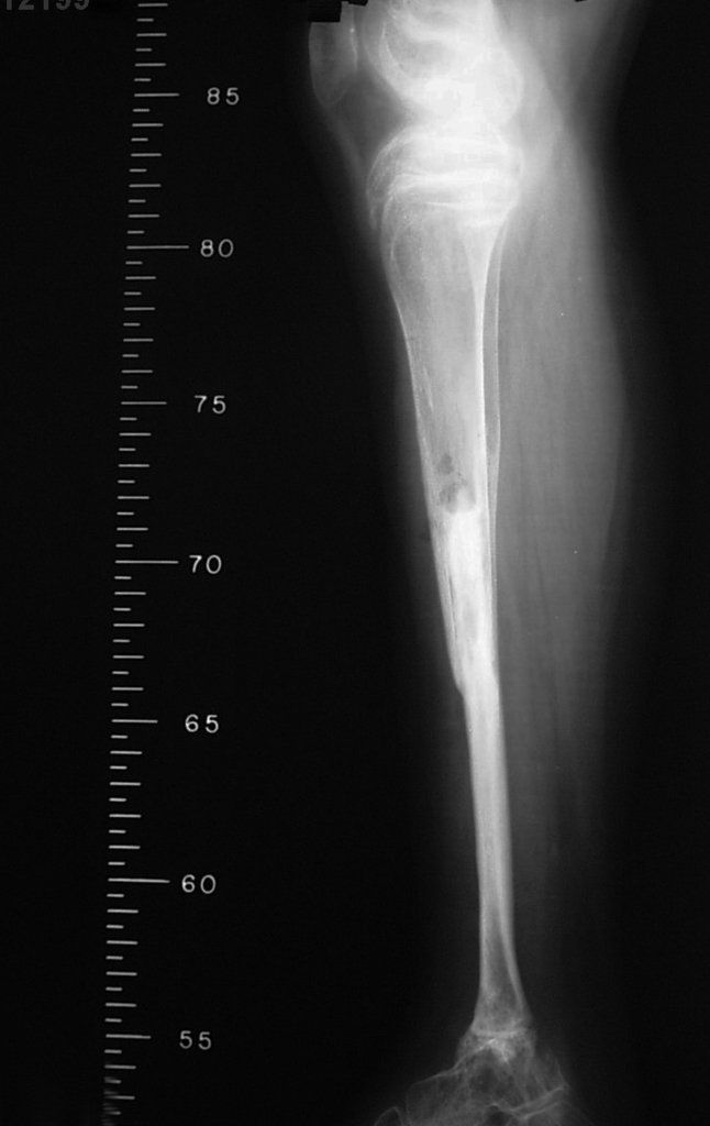 Figura 40: Radiografia perfil, após um ano da cirurgia. Fíbula já tibializada