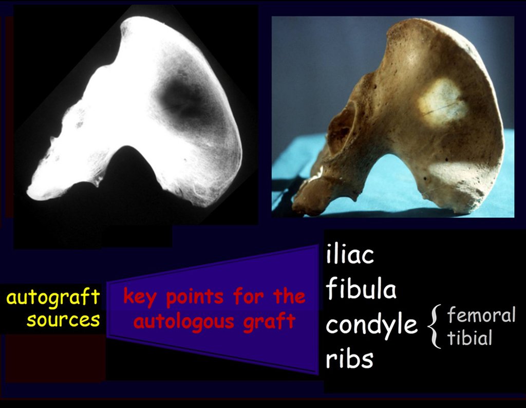 Figura 6: Radiografia da pelve evidenciando área mais escura na asa do ilíaco, correspondente à baixa densidade óssea. Pelve com trans iluminação mostrando que naquela área central as tábuas interna e externa se fundem. Nesta zona NÃO há enxerto.