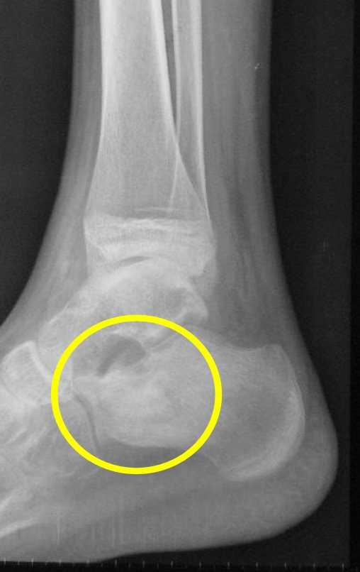 Figura 77: Radiografia de 01/03/2015, perfil, enxerto em integração.