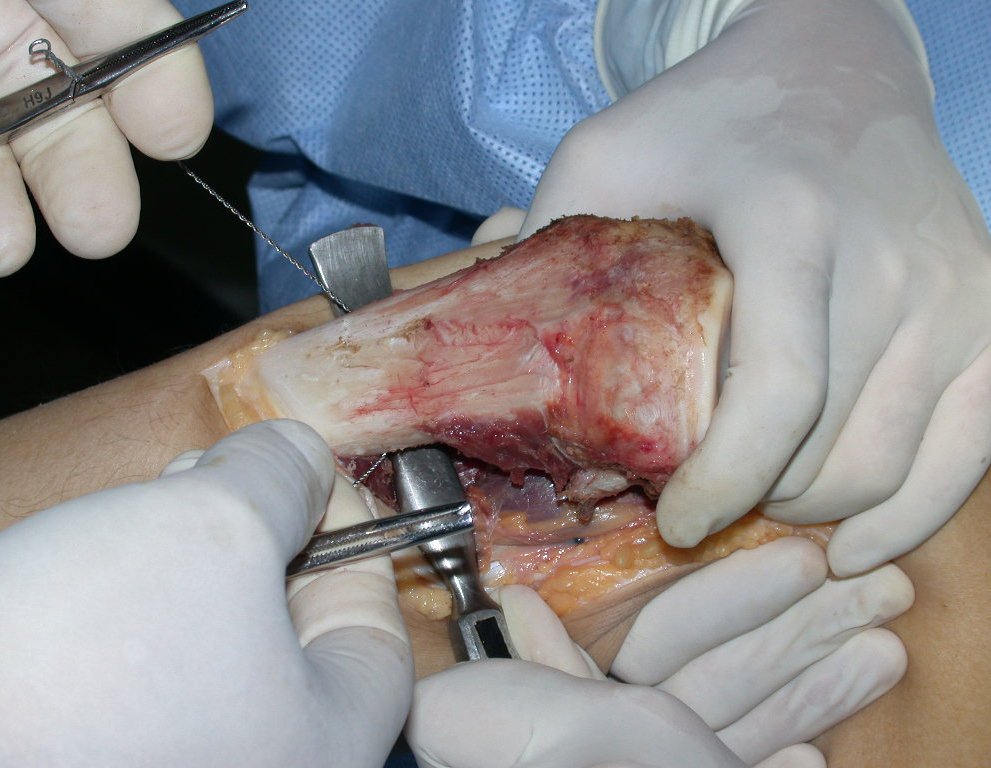 Figura 50: Os tecidos moles são protegidos com um afastador e a serra de Gigli é posicionada para a osteotomia.