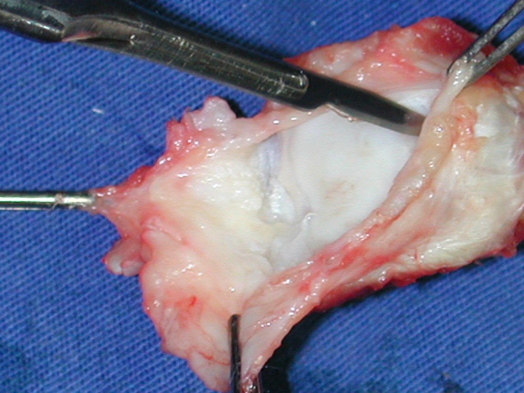 Figura 70: O enxerto, obtido da extremidade proximal da fíbula, deve possuir coto da cápsula articular em toda a sua circunferência, para possibilitar uma reconstrução adequada do punho.