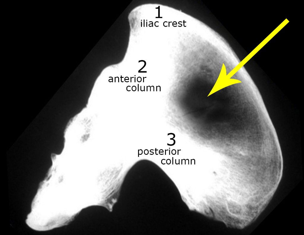 Figura28: Anatomia do ilíaco, radiografia: A seta assinala a área sem enxerto.