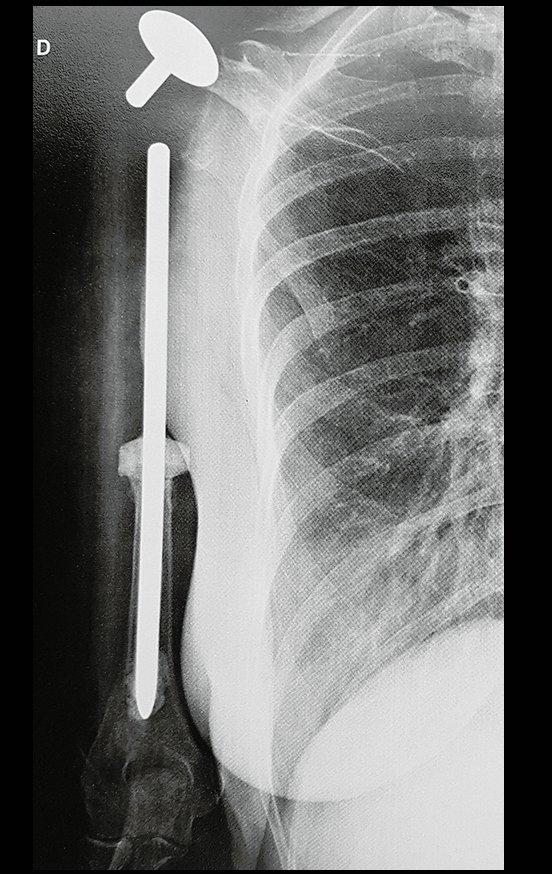 Figura 30: Radiografia após quatorze anos de cirurgia, abril de 2017.