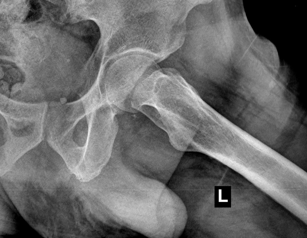 Figura 2: Radiografia em perfil mostrando a lesão de rarefação na região do trocanter menor.