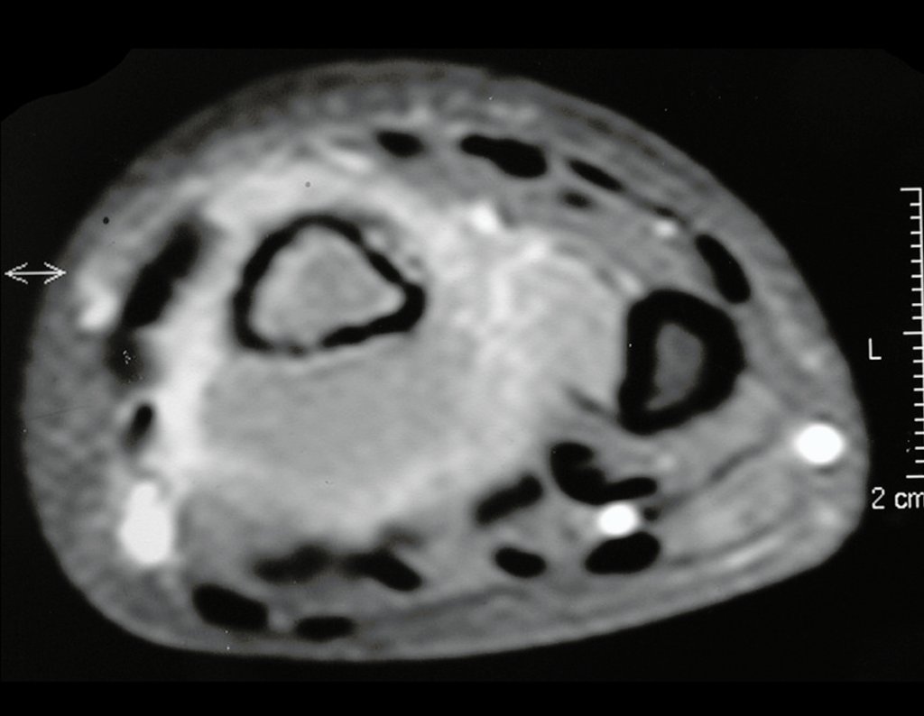 Figura 36: RM ax t1, contraste apenas na periferia e em septos do tumor.