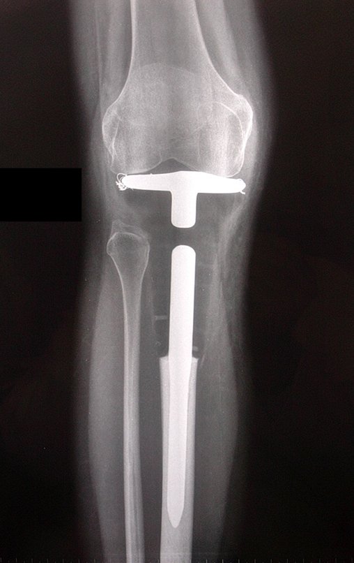 Figura 109: Radiografia na incidência de Frente, pós-operatório de dez meses.