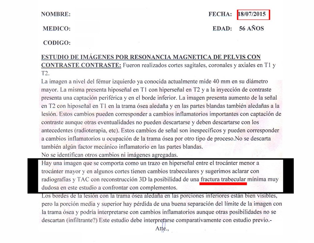 Figura 59: Laudo da RM de Pélvis relatando alterações trabeculares por prováveis traços de fratura.