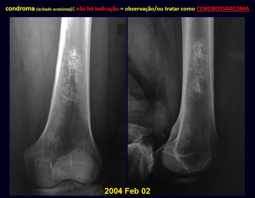 Figura 40: Radiografia com lesão provavelmente cartilaginosa, na metáfise distal do fêmur. Achado casual: CONDUTA = OBSERVAÇÃO.