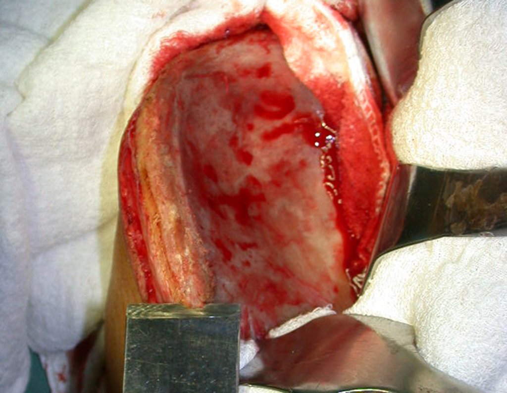 Figura 16: Retirada da cortical superior da crista ilíaca, com osteótomo. Boa hemostasia, sangramento controlado.